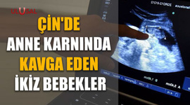 Çin'de anne karnında kavga eden ikiz bebekler